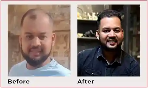 hair transplant results 4