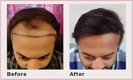 hair transplant results 5