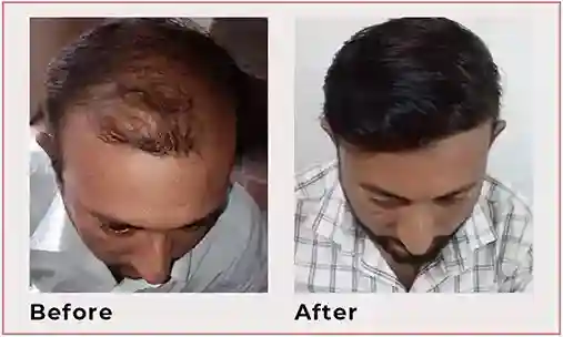 hair transplant results 6